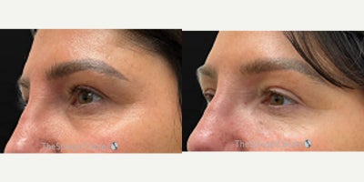 Dermal Fillers before and after photo
