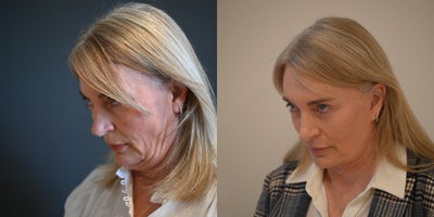 Double Eyelid Surgery before and after photo