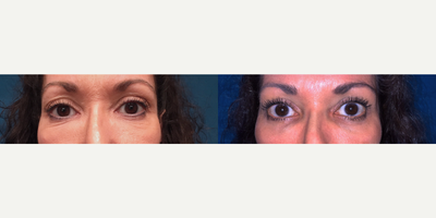 Eyelid Surgery before and after photo
