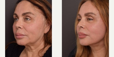 Facelift before and after photo