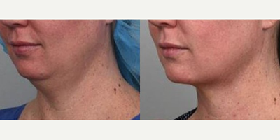 Nonsurgical Neck Lift before and after photo