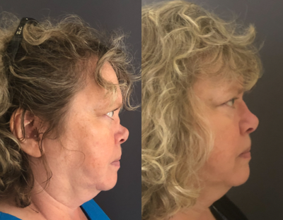 Rhinoplasty before and after photo