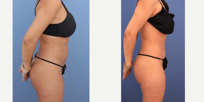 Tummy Tuck before and after photo