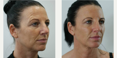 Botox before and after photo