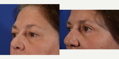 Eyelid Surgery before and after photo