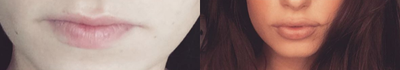Juvederm before and after photo