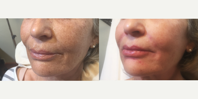 Dermal Fillers before and after photo