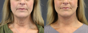 Facelift before and after photo