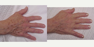 IPL before and after photo