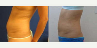 Liposuction before and after photo