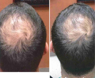 PRP Injections before and after photo