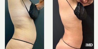 BodyTite before and after photo