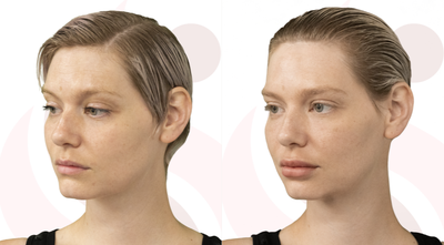 Botox before and after photo