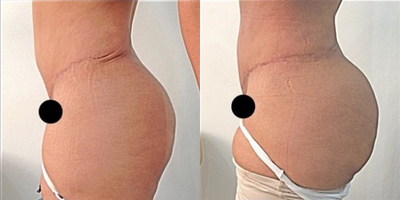 Brazilian Butt Lift before and after photo