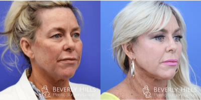 Facelift before and after photo