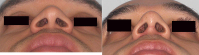 African American Rhinoplasty before and after photo
