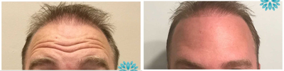 Botox before and after photo