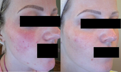 Laser Genesis before and after photo