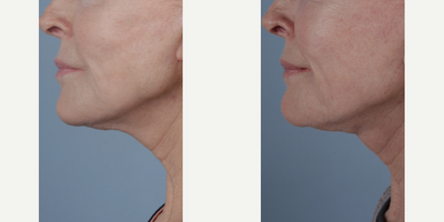 Morpheus8 before and after photo