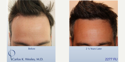 PRP for Hair Loss before and after photo
