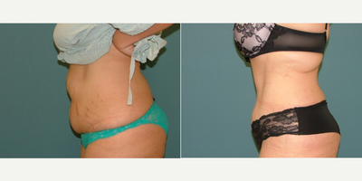 Tummy Tuck before and after photo