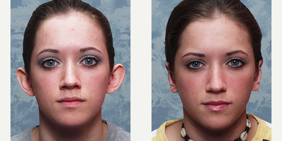 Ear Surgery before and after photo