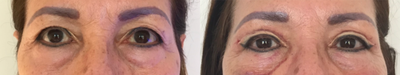 Eyelid Surgery before and after photo
