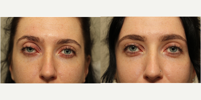 Ptosis Surgery before and after photo