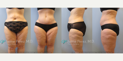 Tummy Tuck before and after photo