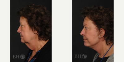 Lower Facelift before and after photo