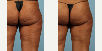 Cellfina before and after photo