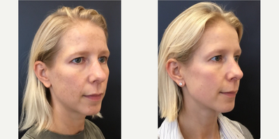 Chemical Peel before and after photo
