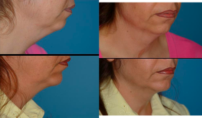 Chin Implant before and after photo
