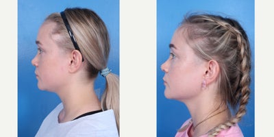 Chin Liposuction before and after photo
