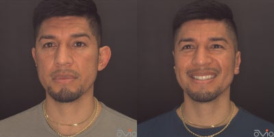 Ear Surgery before and after photo