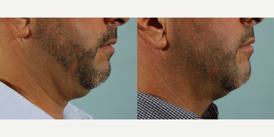 Kybella before and after photo
