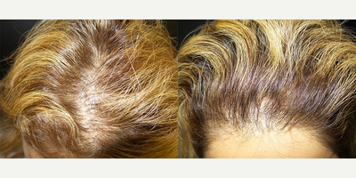 PRP for Hair Loss before and after photo
