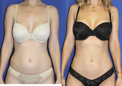 Smart Lipo before and after photo