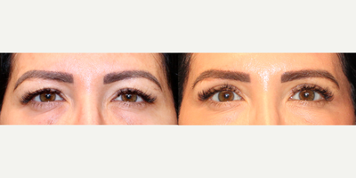 Eyelid Surgery before and after photo