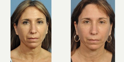 Facial Fat Transfer before and after photo