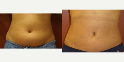 Liposuction before and after photo