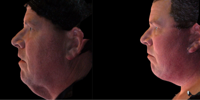 Neck Lift before and after photo