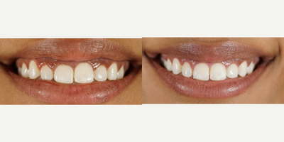 Smile Makeover before and after photo