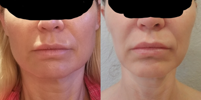 Botox for TMJ before and after photo