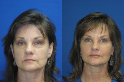 Botox before and after photo