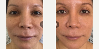 Dermal Fillers before and after photo