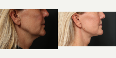 Facelift before and after photo