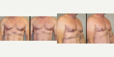 Liposuction before and after photo