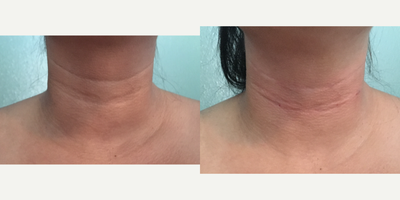 Belotero before and after photo