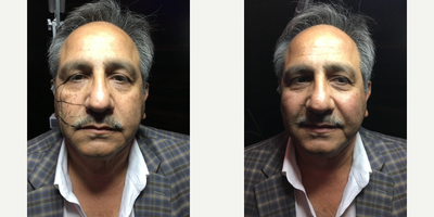 Collagen Injection before and after photo